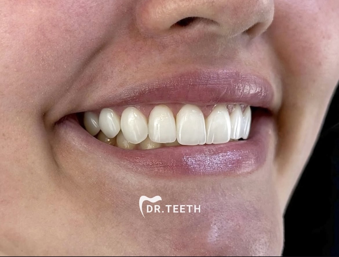 After veneers smile case