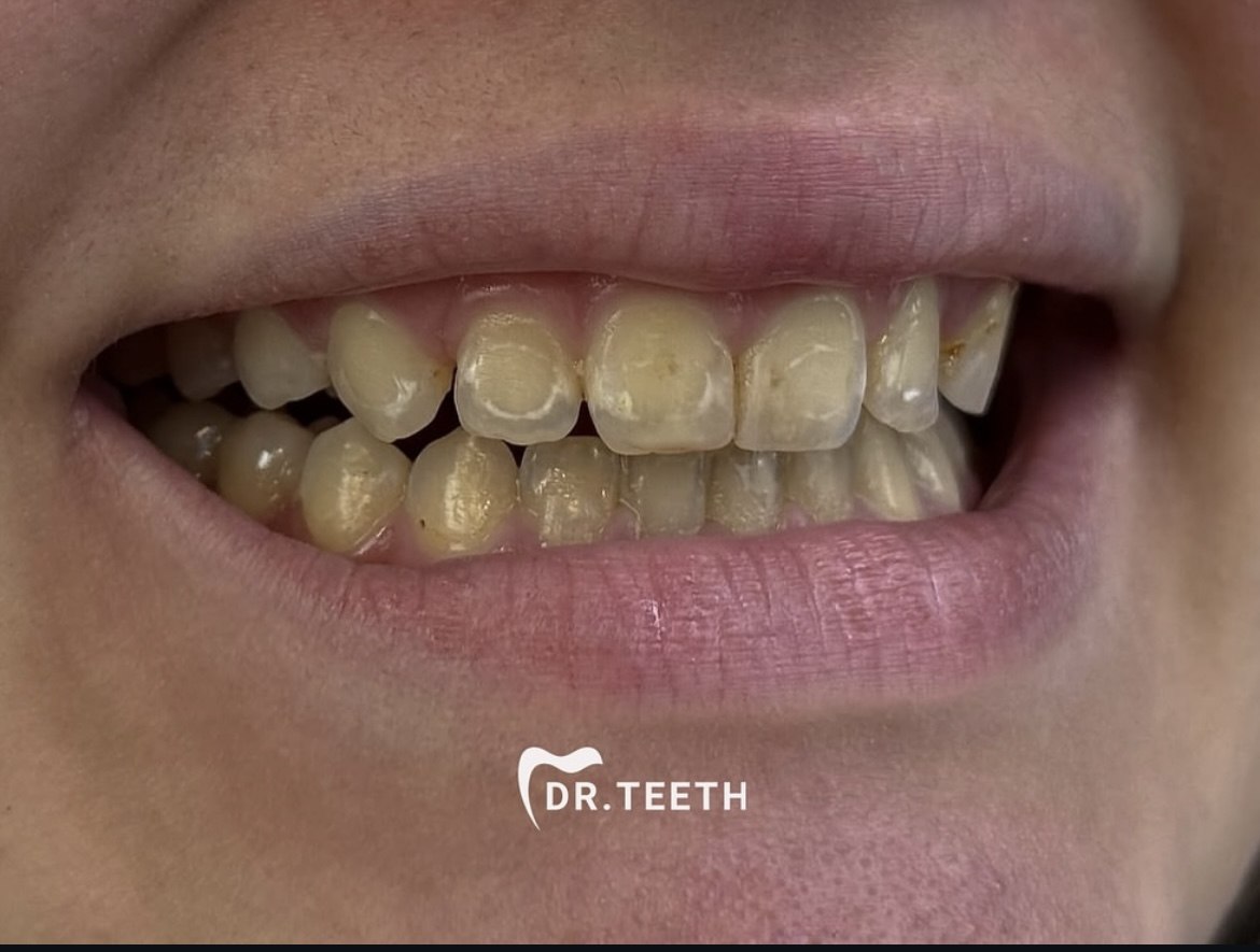 Before veneers smile case