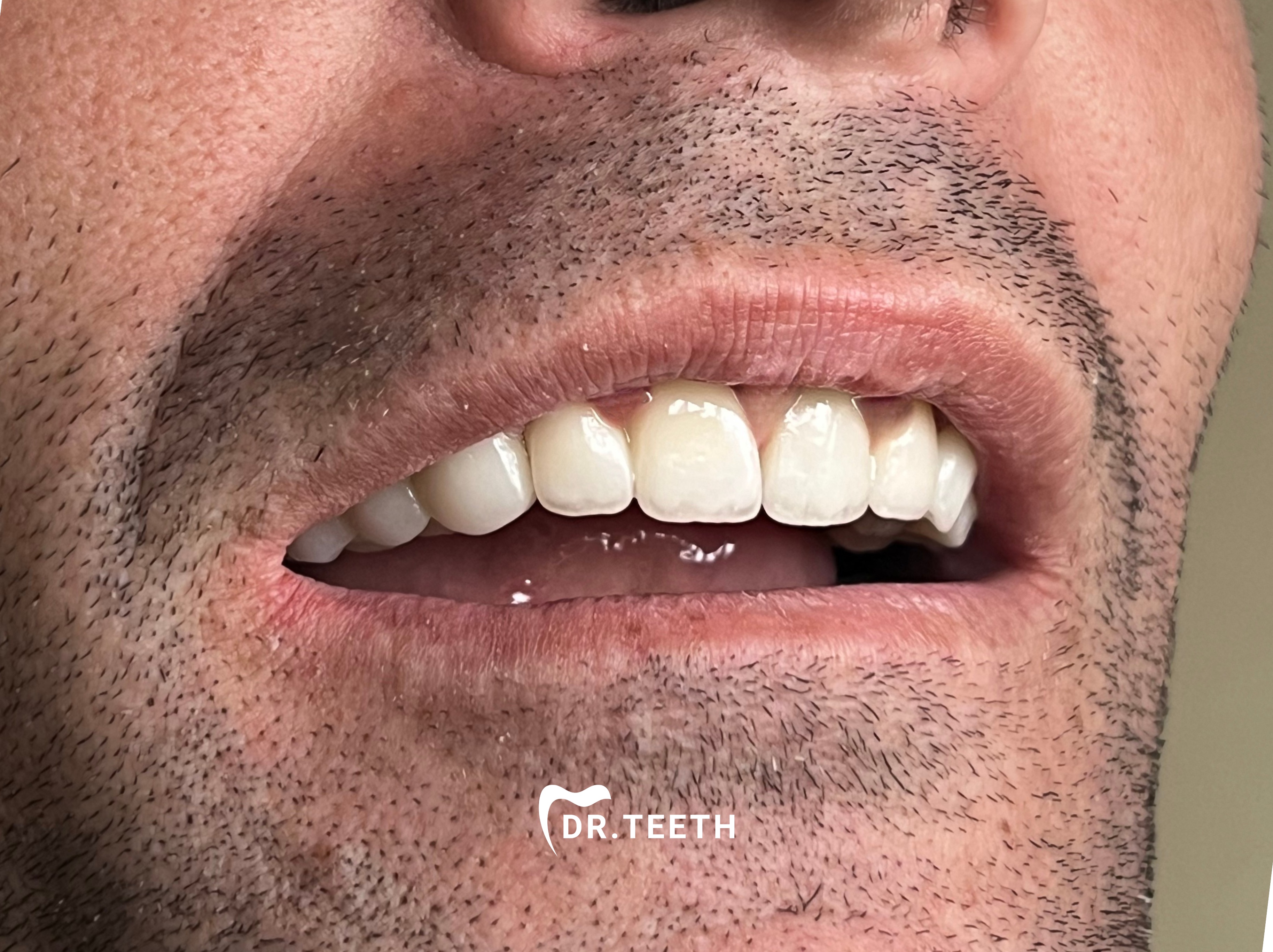 After zirconia crown treatment
