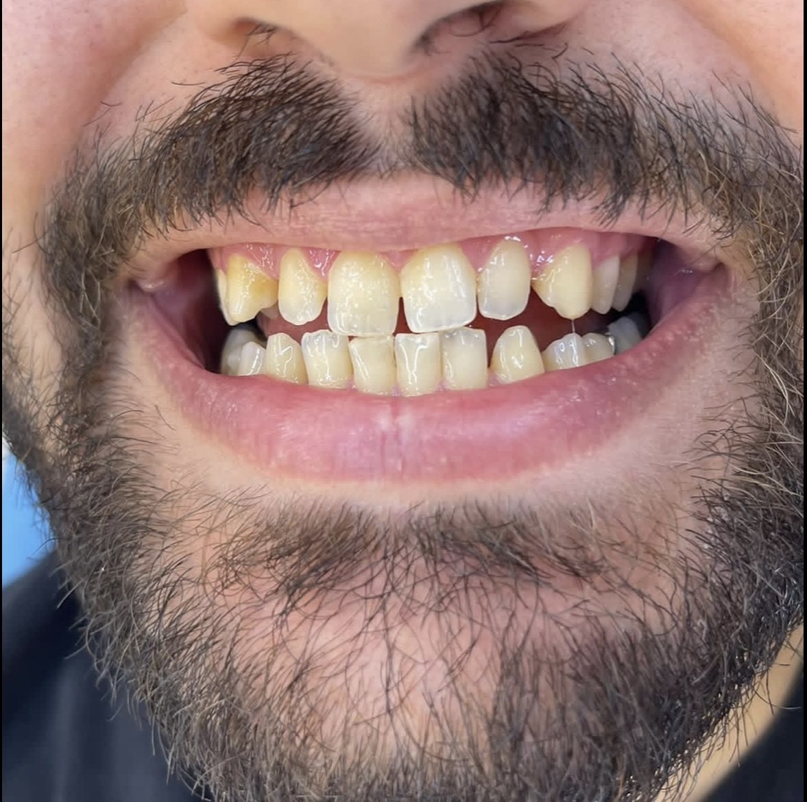 Before zirconia crown treatment