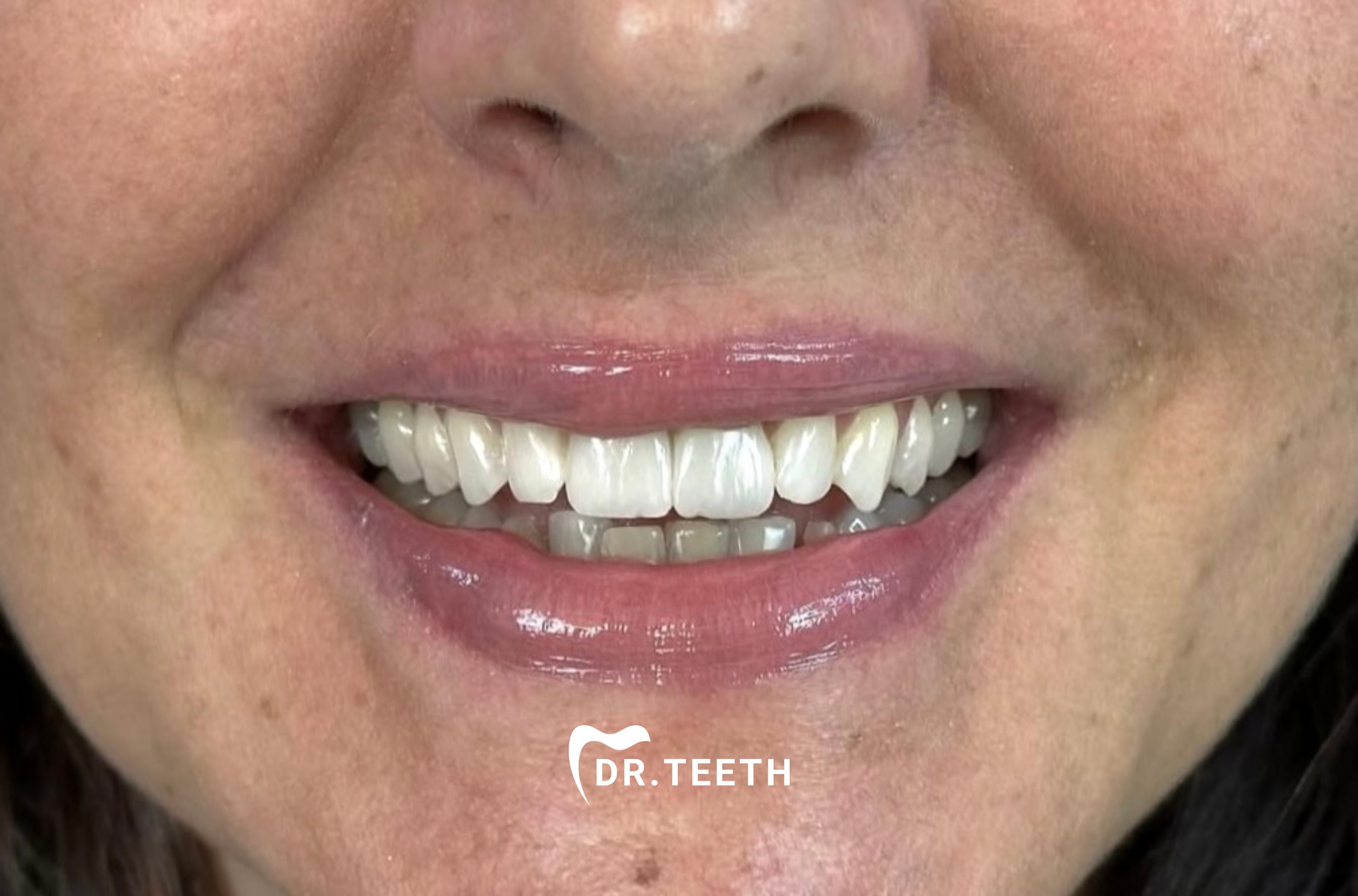 After smile makeover treatment
