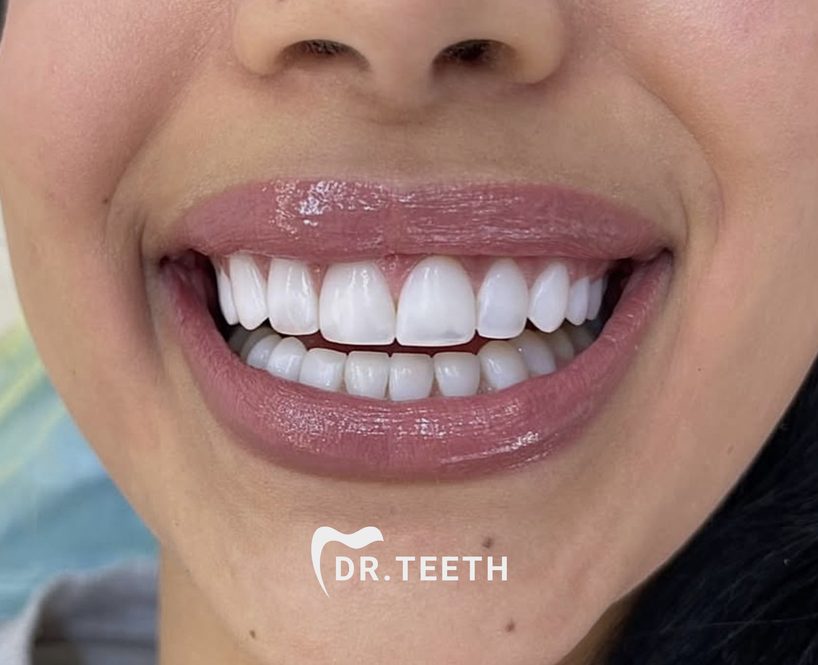 After smile makeover
