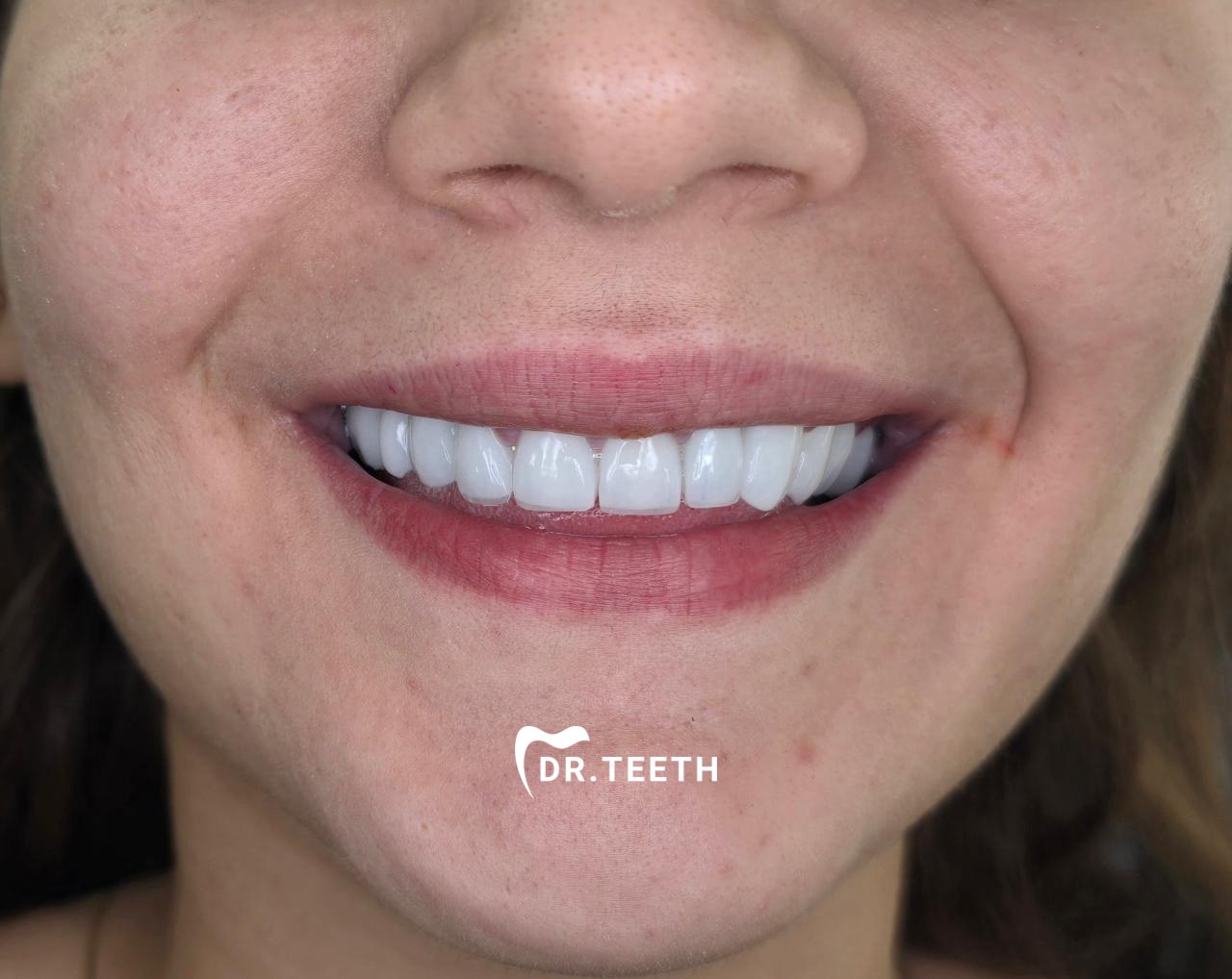 After full mouth rehabilitation