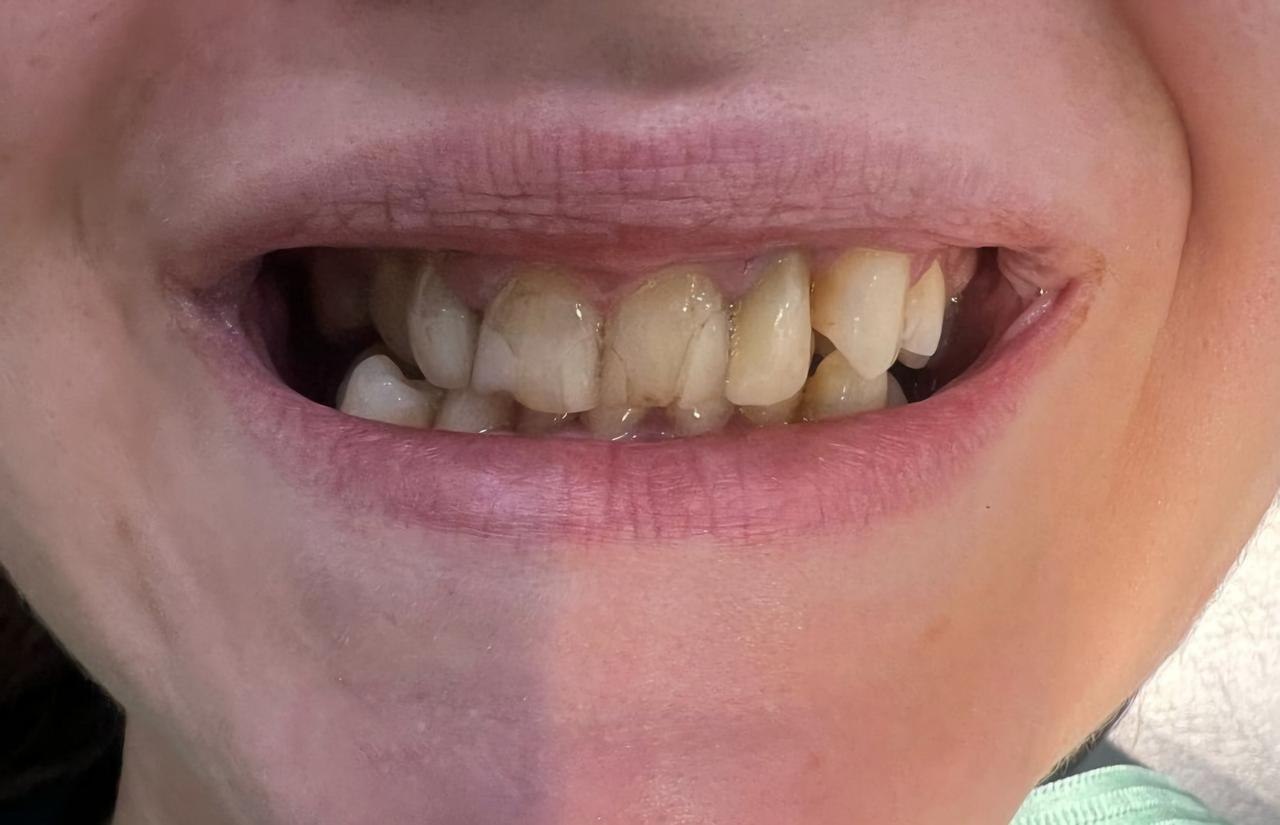 Before full mouth rehabilitation
