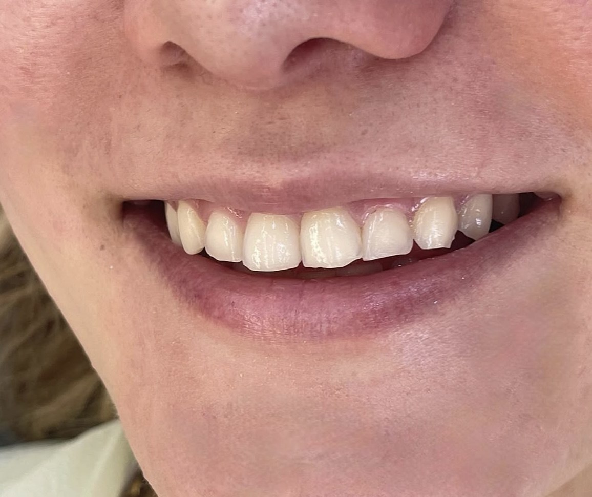 Final smile result view by DR. TEETH